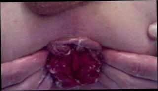 Video 133101601: fisting gape prolapse, prolapse gay, gaping man, gay parte