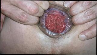 Video 1475956603: gaping prolapsed ass hole, anal gape prolapse, fingering anal gape, pov anal gape, anal gape fetish, solo anal gaping, solo amateur fingering, pov finger fuck, solo male fingering, hardcore anal gape, gaping ass hole stretched, anal gape training