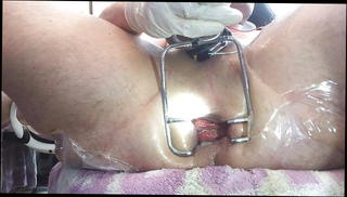 Video 516112401: gaping anal speculum, gaping fisting anals, gay anal gape, extreme anal gape, anal gape hd
