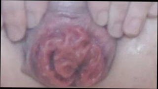 Video 1571827731: anal gape prolapse, piss gape anal, gaping hole prolapse, skinny piss, hardcore anal gape, amateur anal gape, best anal gape, anal gape close, piss straight, good piss, piss yoga, great piss, urethra