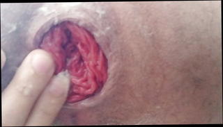 Video 1022501901: self anal fisting prolapse, prolapse gay, prolapse close, amateur anal fisting, anal fisting hd