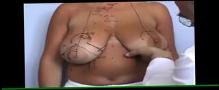 Video 274515101: straight medical, breasts