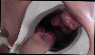 Video 792491704: gaping fisting anals, amateur anal gape, prolapsed ass holes, extreme prolapse, inside ass hole