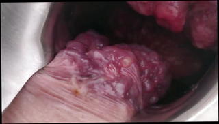 Video 729031201: prolapsed ass holes, extreme prolapse, gay ass anal, inside ass hole