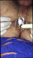 Video 194171801: prolapsed ass holes, ass hole plugged, plug first, gay man ass hole